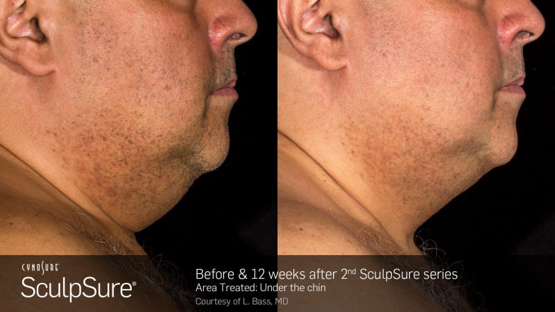 Liposuction vs. SculpSure Orange County