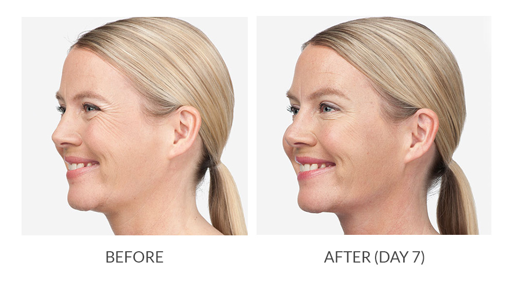 Before and after results for a patient who received Botox