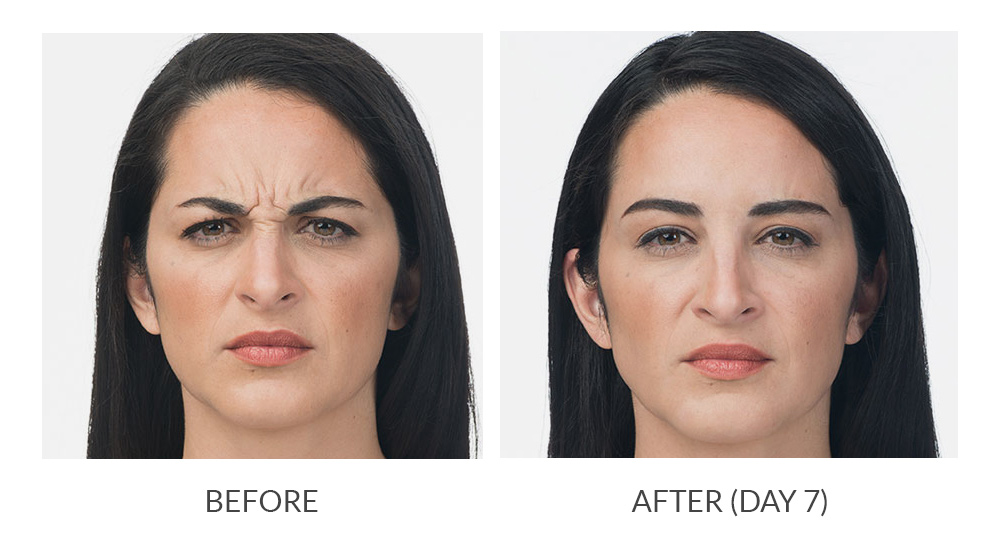 Before and after results for a patient who received Botox