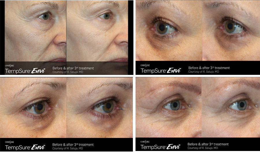 Before and after TempSure Envi results